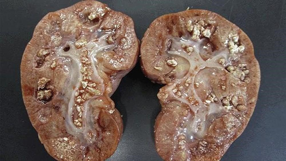 Cách trị sỏi thận hiệu quả và an toàn – Những phương pháp chuyên nghiệp và hữu hiệu