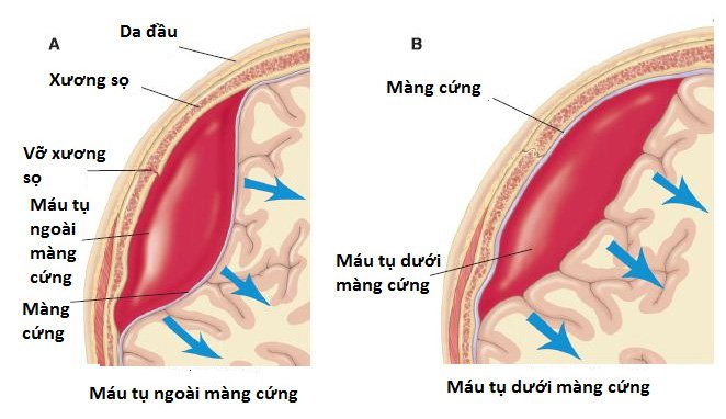 Tất tần tật thông tin về thổ huyết - từ khái niệm đến cách chữa bệnh hiệu quả 2