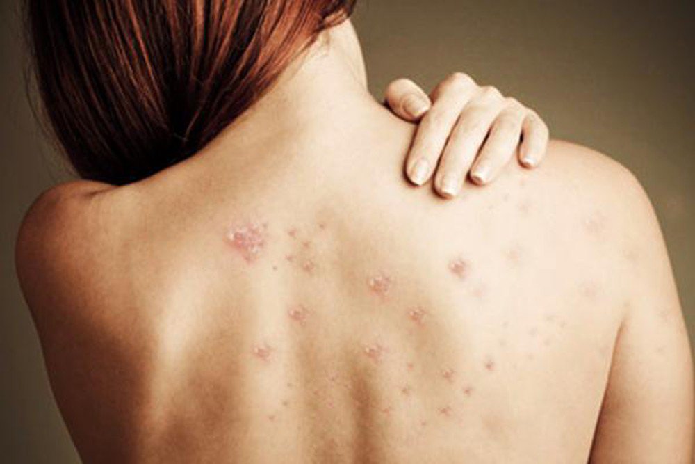 Cách trị mụn lưng tại nhà hiệu quả và an toàn – Hướng dẫn chi tiết từ chuyên gia
