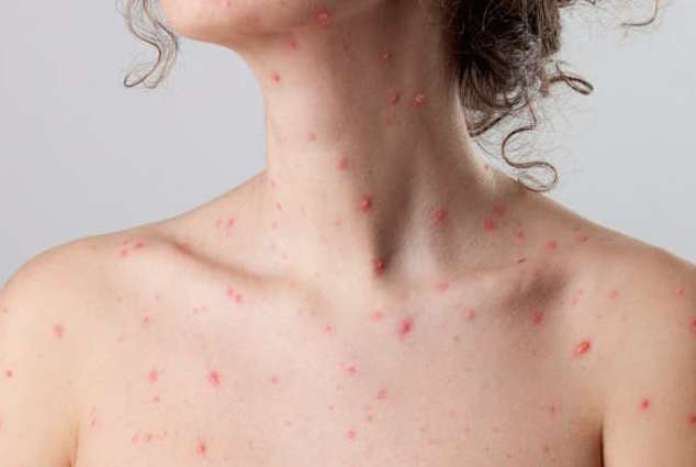 Tìm hiểu về chế độ ăn uống phù hợp cho bệnh nhân thủy đậu kiêng gì?