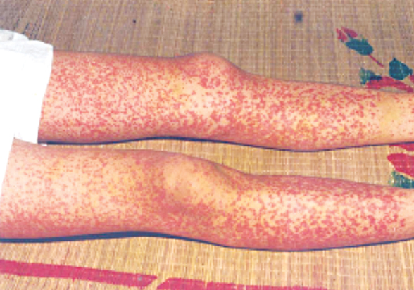 Viêm mao mạch dị ứng – Nguyên nhân, triệu chứng và phương pháp điều trị hiệu quả
