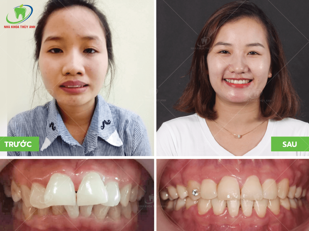 Niềng răng có đau không? Những điều cần biết khi niềng răng