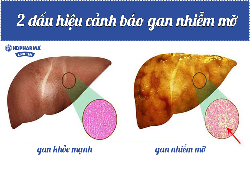 Diếu hiệu gan nhiễm mỡ – một căn bệnh thường gặp ở người trưởng thành