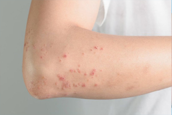 Bí quyết giúp giảm nguy cơ bị dị ứng da và khắc phục nổi mẩn đỏ hiệu quả