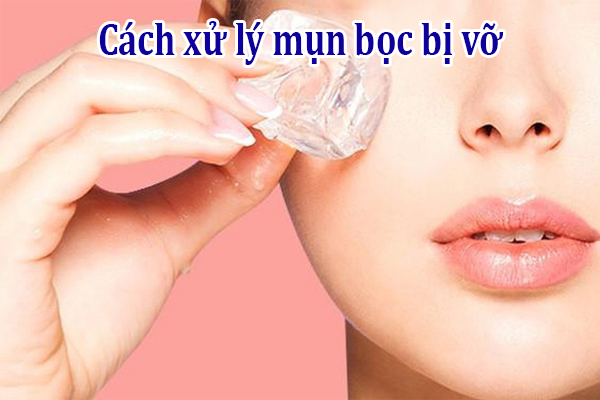 Cách xử lý mụn bọc hiệu quả tại nhà: Bí quyết đơn giản, an toàn và hiệu quả