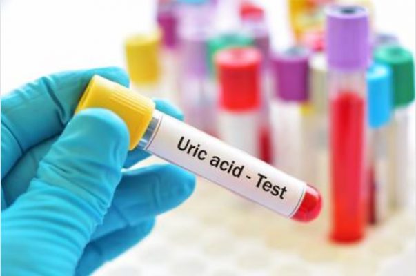 Tất tần tật về tăng acid uric máu: nguyên nhân, triệu chứng và cách điều trị hiệu quả