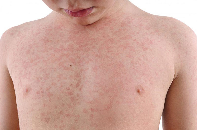 Chia sẻ: Bị sốt nên uống nước gì? Những loại nước giúp giảm sốt hiệu quả