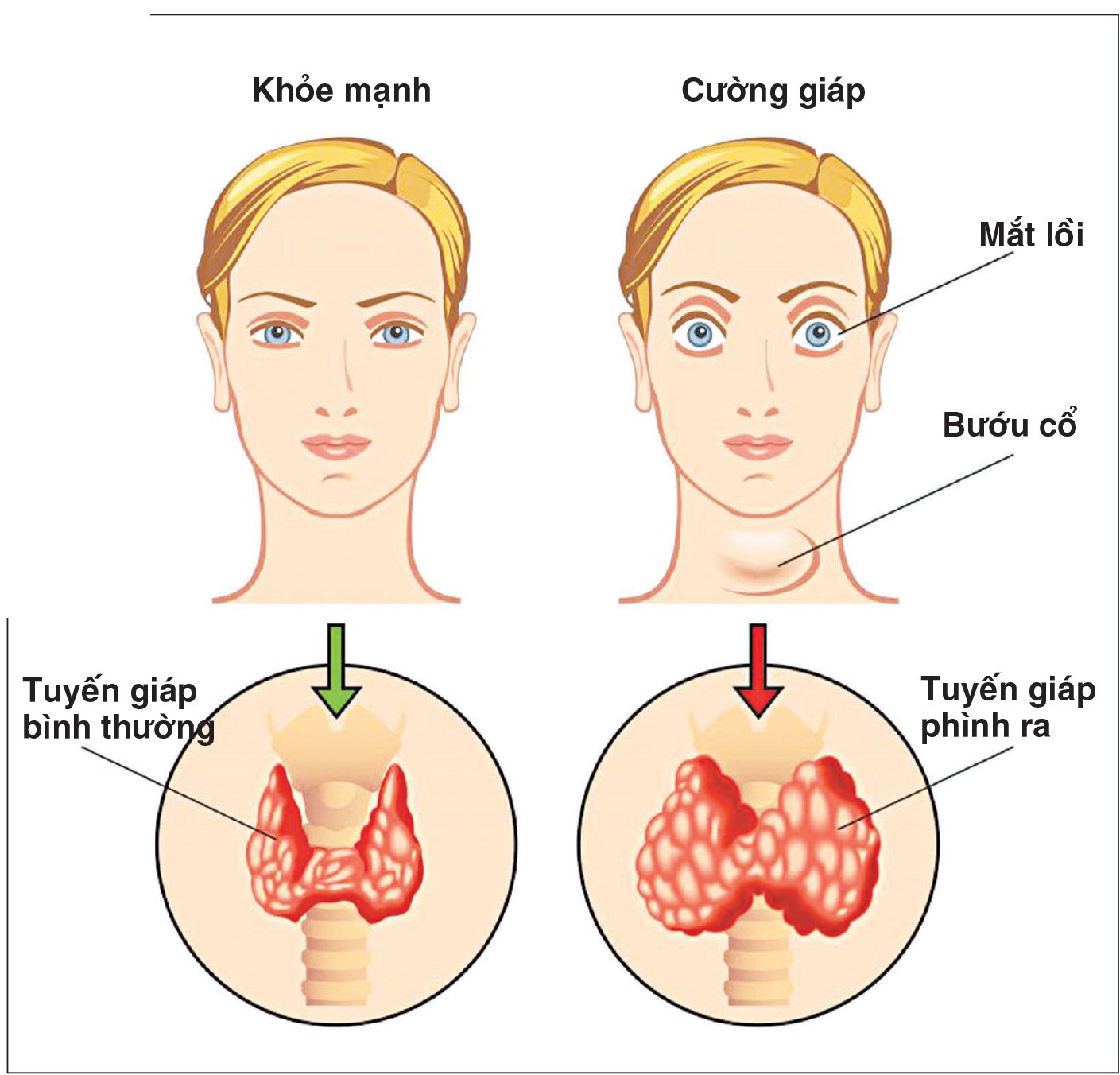 dấu hiệu bướu cổ