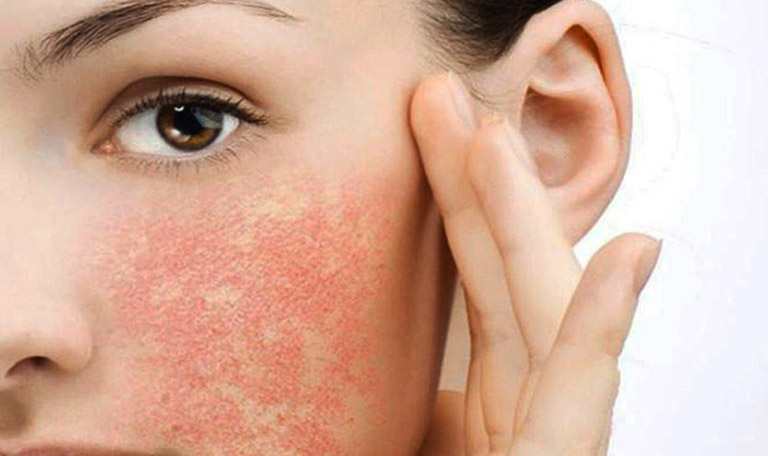 Dị ứng da: Nguyên nhân, triệu chứng và cách điều trị hiệu quả – Tư vấn chuyên gia về dị ứng da