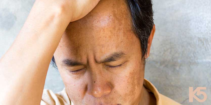 Nám da nam giới: Nguyên nhân, triệu chứng và cách điều trị hiệu quả