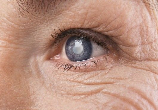 Đục thủy tinh thể ở người già: Nguyên nhân, triệu chứng, điều trị và phòng ngừa 2