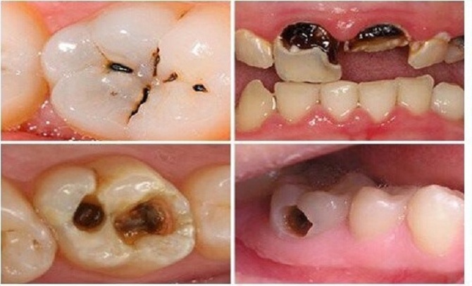 Viêm nha chu uống thuốc gì – Những lời khuyên và thông tin hữu ích