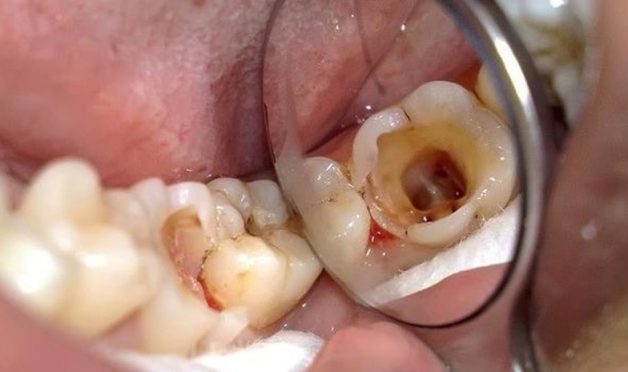 Phương pháp điều trị răng số 7 bị sâu vỡ hiệu quả và bền vững