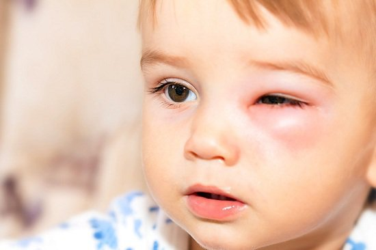 Giải pháp đau mắt: Những thực phẩm cần kiêng khi bị đau mắt