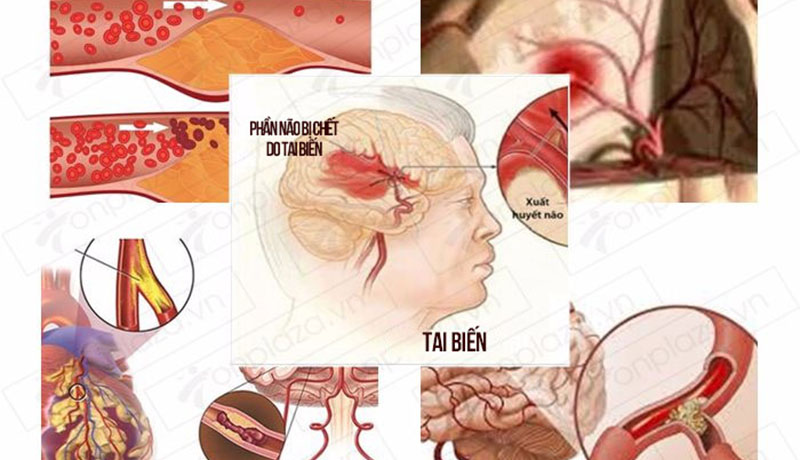 tai biến mạch máu não