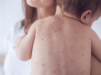 Bí quyết điều trị bị thủy đậu tắm lá gì hiệu quả | Cách chữa bệnh thủy đậu bằng lá vô cùng đơn giản