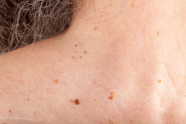 Cách trị mụn thịt hiệu quả với tỏi - Bí quyết làm sạch da chỉ trong vài ngày