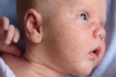 Giải pháp chăm sóc trẻ bị dị ứng nổi mẩn đỏ khắp người hiệu quả và an toàn
