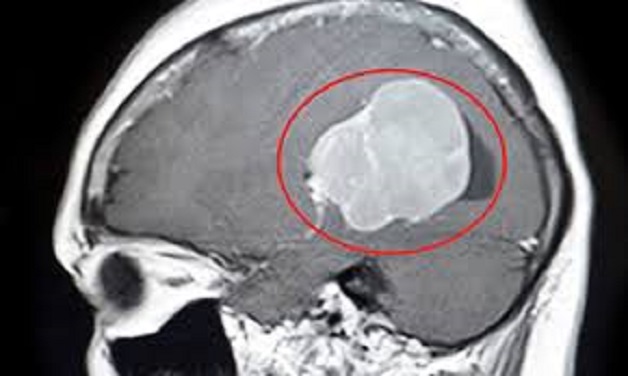 Đau đầu sau gáy: nguyên nhân, triệu chứng và giải pháp trị triệt để và hiệu quả