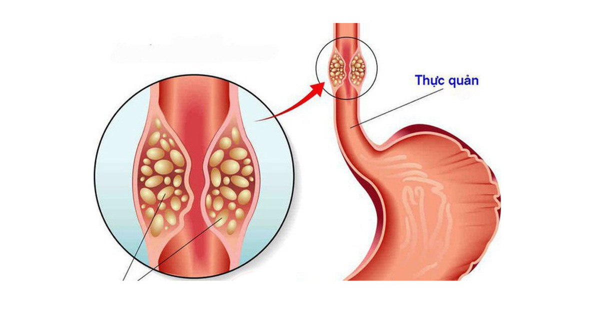 Thông tin mới nhất về chữa trị ung thư thực quản – Cập nhật từ chuyên gia