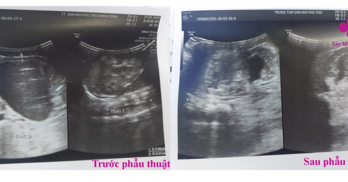 Phương pháp hiệu quả điều trị hẹp khúc nối bể thận