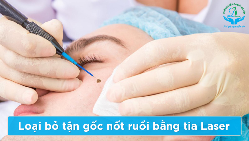 5 Phương pháp tự nhiên trị sẹo lõm hiệu quả tại nhà