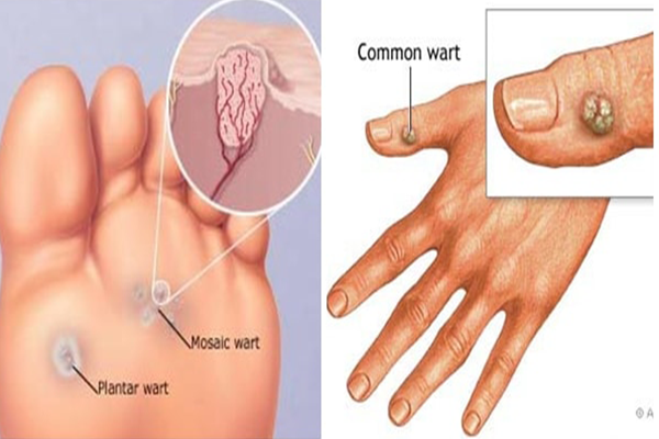 Cách trị mụn cóc tại nhà dân gian hiệu quả và an toàn