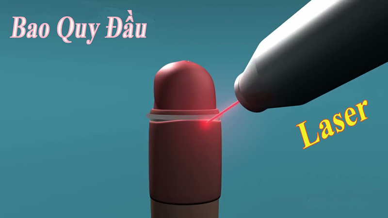 Cắt bao quy đầu – Dịch vụ chất lượng, tận tâm và uy tín tại các phòng khám uy tín