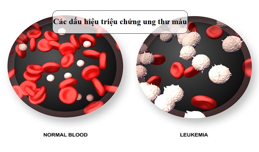 Những triệu chứng ung thư máu: Tìm hiểu và phòng tránh bệnh hiệu quả | SEO optimized title