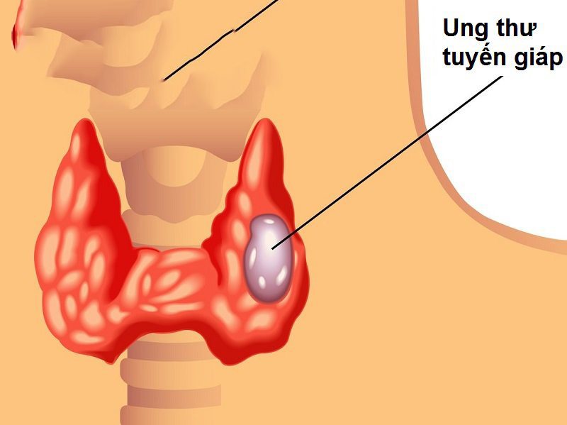 Bướu cổ: Thông tin chi tiết về nguy cơ và cách điều trị hiệu quả