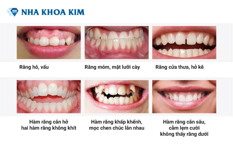 Cập nhật chi tiết chi phí niềng răng mắc cài kim loại mới nhất