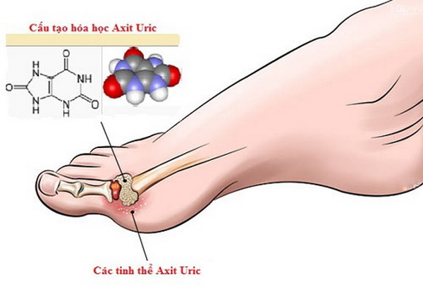 Thực đơn đặc biệt giúp loại bỏ acid uric: Thức ăn đào thải acid uric hiệu quả