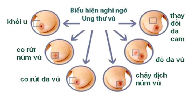 Triệu chứng ưng thư vú - Các dấu hiệu cần quan tâm và phòng ngừa hiệu quả