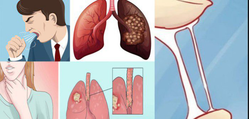 Dấu hiệu bị ung thư phổi: Các triệu chứng và phương pháp điều trị – Tư vấn chuyên gia