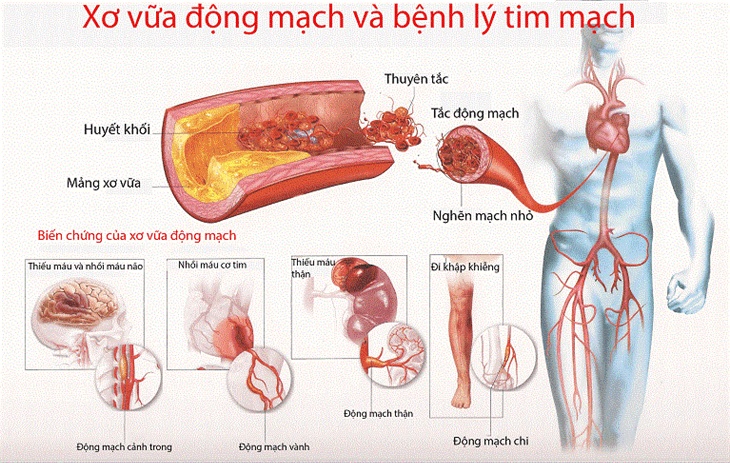 Giải pháp hiệu quả cho vấn đề thiếu máu cơ tim