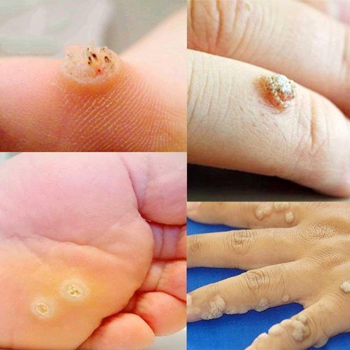 Cách trị mụn cóc tại nhà dân gian hiệu quả và an toàn