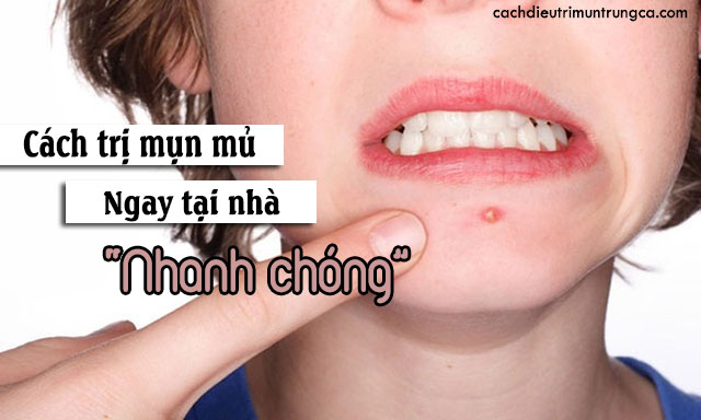 Cách trị mụn lưng tại nhà hiệu quả và an toàn - Hướng dẫn chi tiết từ chuyên gia