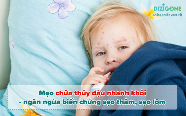 Cách chữa thủy đậu ở người lớn nhanh và hiệu quả nhất