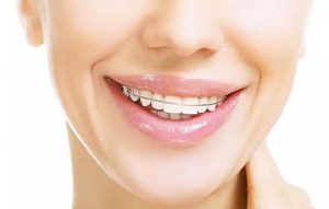 5 cách đeo hàm giúp duy trì vẻ đẹp răng hoàn hảo và ngăn chặn răng chạy hiệu quả