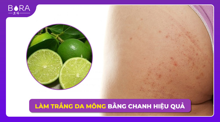 Trị thâm mông hiệu quả với cách sử dụng Vaseline – Tư vấn chuyên gia và đánh giá sản phẩm