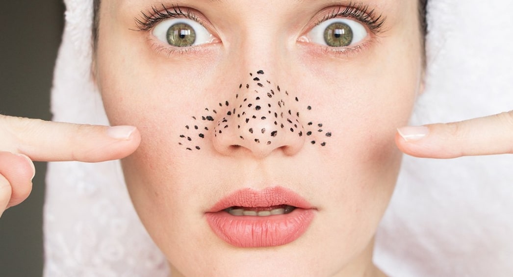 Trị mụn đầu đen ở mũi hiệu quả tại nhà