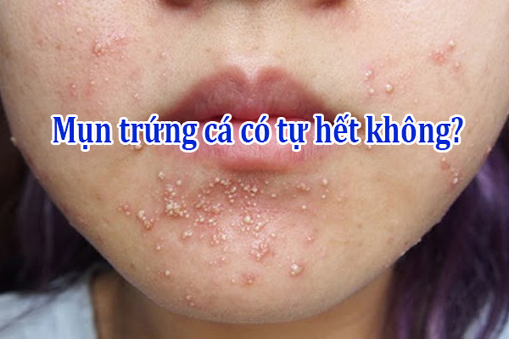 Mụn trứng cá có tự hết không? Tìm hiểu về nguyên nhân và cách điều trị hiệu quả