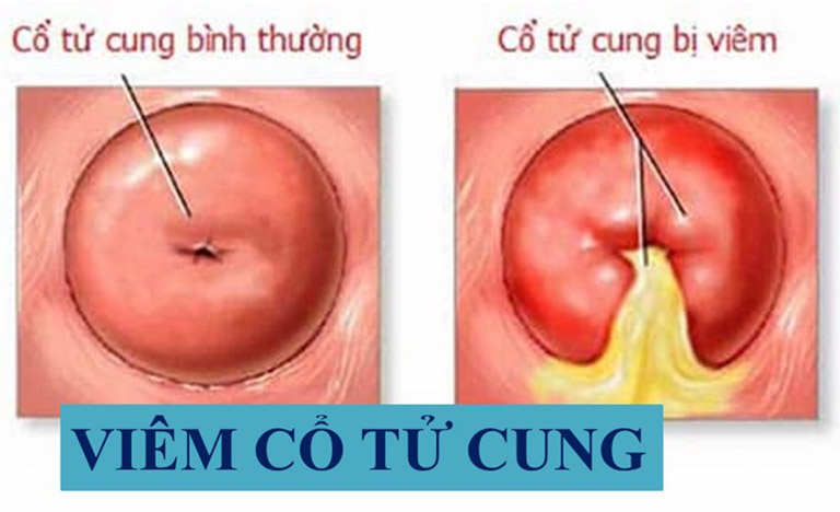 Giải pháp trị nấm trắng ở vùng kín hiệu quả và an toàn