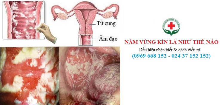 Giải pháp trị nấm trắng ở vùng kín hiệu quả và an toàn