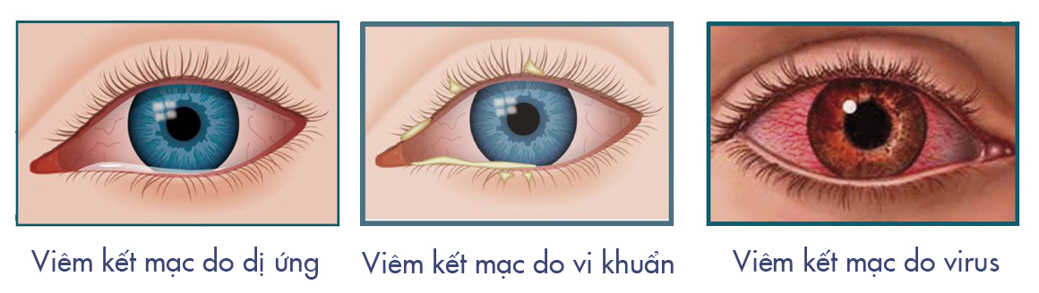 Thuốc nhỏ mắt viêm kết mạc chiết xuất tự nhiên chất lượng cao
