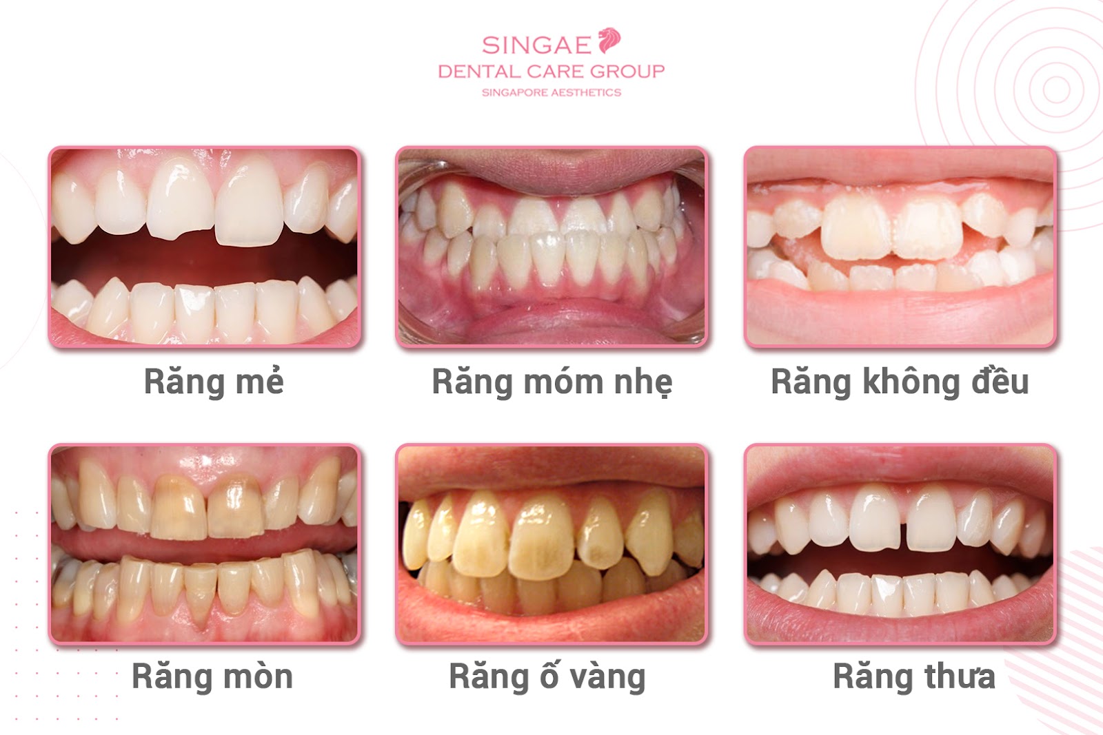 Giá niềng răng cho người lớn: Thông tin chi tiết và chi phí niềng răng hiệu quả