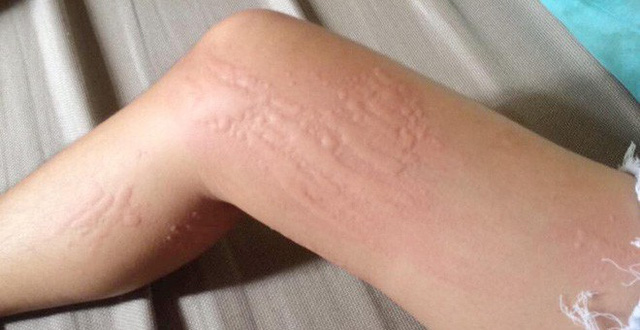 Nổi mề đay vào ban đêm: Nguyên nhân và cách khắc phục nổi mề đay vào ban đêm