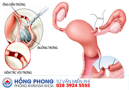 Tắc vòi trứng – Giải pháp nhanh chóng và hiệu quả | Cách phòng tránh và xử lý tắc vòi trứng