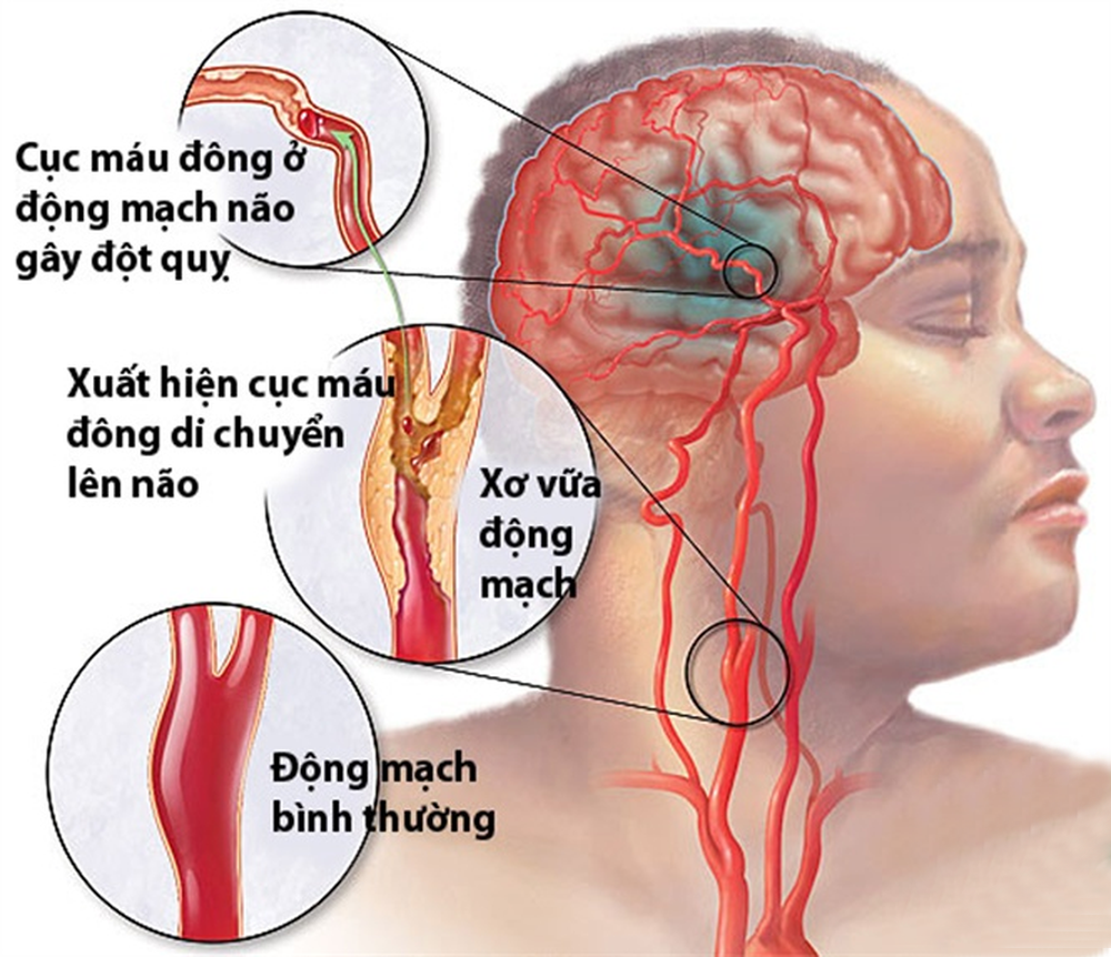 Tai biến mạch máu não: Nguy hiểm cho bộ não