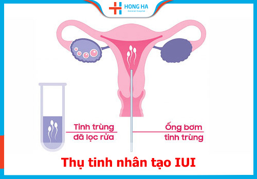 Thụ tinh nhân tạo – Cập nhật thông tin mới nhất và đầy đủ từ chuyên gia y tế hàng đầu